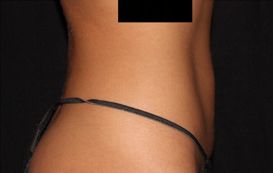 Coolsculpting Before And After - Shaping My Waist - Whistler